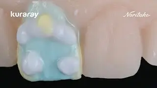 Fractured Incisor Restoration on Zirconia | CERABIEN MiLai Micro-Layering