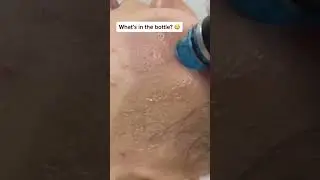 Hydra facial for acne blackhead extraction #fyp #ghana #viral