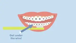 Take Care of Your New Braces with Family Orthodontics!