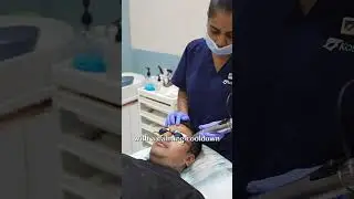 Q Switch Laser