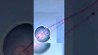 OpticLens&trade; - Eye care