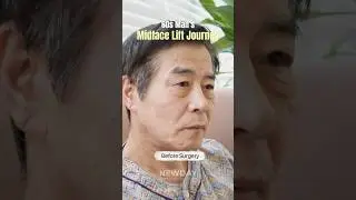 A man in his 60s takes on his first plastic surgery challenge 👨&zwj;🦳 #MidfaceLift