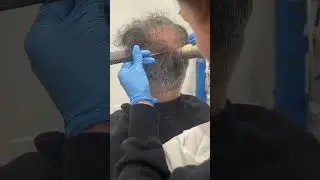 Transform your scalp against hair loss with our Sylfirm treatment! 🌟✨