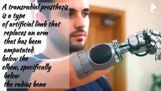 Trans Radial Prosthesis.#prosthetics #robotics #youtube 