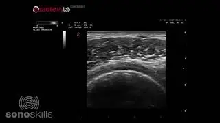 Supraspinatus full thickness tear