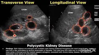 liver ultrasound Normal vs abnormal kidney ultrasound #UltrasoundScan #JellyProbe #kidney #liver