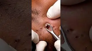 Gentle Jawline Extraction with Sebum | ASMR #ASMR #ASMRShorts #ASMRVideo #ASMRCommunity #ASMRWorld