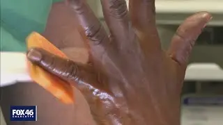 Surgeon from Salisbury VA Medical Center performs hundreds of wide-awake hand surgeries for veterans