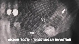 Impacted Teeth| Wisdom tooth| Disturbances in eruption 
