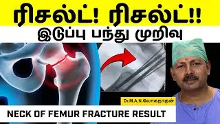 “ரிசல்ட்! ரிசல்ட்!!”இடுப்பு பந்து முறிவுNECK OF FEMUR FRACTURE RESULTS!