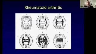 Patologia oncologica e infettiva dell'osso  - Prof. Sconfienza  e Prof. Guglielmi