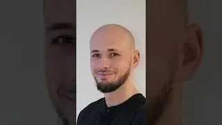 Drawing with Murat Makascı! I Hair Transplant