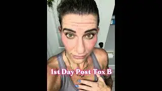 Not seeing results from Botox anymore?