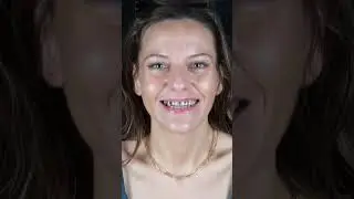 All on 4 Dental Implants in Los Algodones, Mexico: Lisa's Dental Transformation!