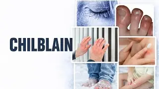 Chilblains Explained: Causes, Symptoms,Homeopathic Treatment & Prevention | Winter Skin Care