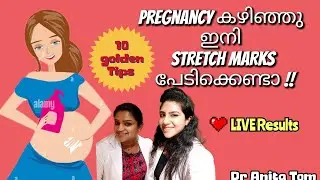 🔴🪙10 Golden Tips✅ | Stretch Mark Removal | Treatments | Laser | Skincare | Pregnancy| Dr Anita Tom