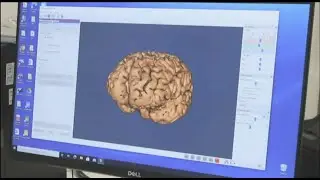 STIMOLAZIONE MAGNETICA TRANSCRANICA - DR. DANIEL LEVI
