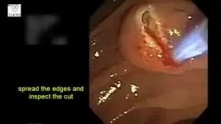 Needle knife cannulation (video3)