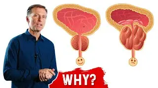 Hidden Reason for Prostate Enlargement &ndash; Dr.Berg