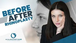 Reshaping Beauty: Melena's Rhinoplasty Story with Dr. Muhammet Dilber
