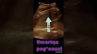 22 HAFTALIK XOMILA #baby #ultrasound #pregnant #spine #spinehealth