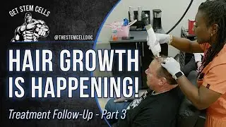 Stem Cells & Exosomes for Hair Restoration | Real Results After 30 Days