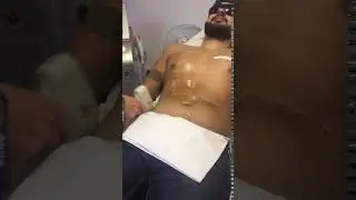 Pain free laser hair removal mans chest, Sutton coldfield