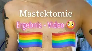 Ergebnis & Heilungsprozess! 😍🩹 (TW) I Michelle Fuhrmann