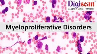 Myeloproliferative Disorders Made Easy &ndash; A Popular Digiscan Lecture Series