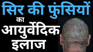 Ayurvedic Treatment for Scalp Folliculitis: Causes & Home Remedies