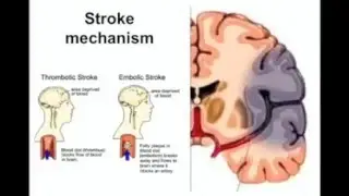 Dr Amy Brodtmann - Visual syndromes after stroke: Cortical blindness and blindsight