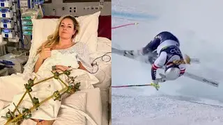 Lindsey Vonn Gives Video Update After Breaking Leg At Olympics