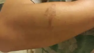Paint stripper burning skin