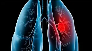 will a humidifier help pneumonia