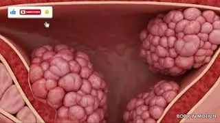 Endometrial Cancer | 3D Anatomy Animation