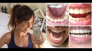 Experiencia con Invisalign y diseño de sonrisa