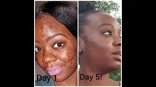HOW TO CLEAR CYSTIC ACNE| ALL NATURAL PRODUCTS! | Wella Novee