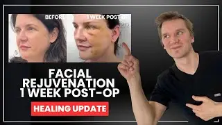 Facial Rejuvenation Journey: 1 Week Post-Op Deep Plane Facelift & more!