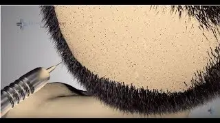 ► The FUE Hair Transplant and Perkutan Technique ◄  Elithairtransplant