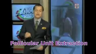 Follicular Unit Extraction | Dr. Arambulo | interview by Kabayan Noli