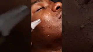 &ldquo;Men&rsquo;s ASMR Deep Pore Cleansing | Blackhead & Whitehead Removal with Soft Suction&rdquo;