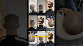 Scalp micropigmentation hair transplant scar camouflage session 1 #smp #scalpmicropigmentation