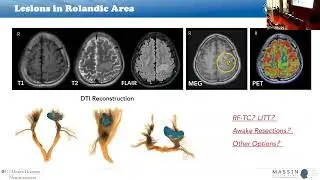 LITT and RNS in epilepsy surgery | MASSIN Congress Day 4 | Session 16, Talk  3