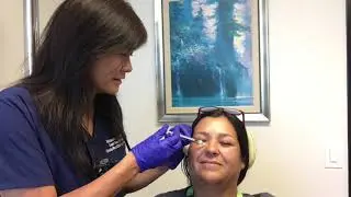Botox to bunny lines