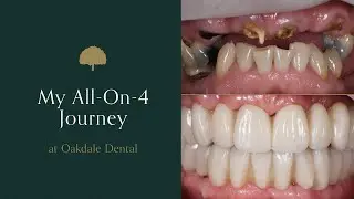 My All-On-4 journey