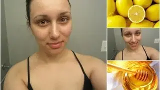 Honey Face Mask For Acne Scars & Dark Spots