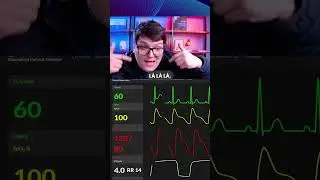 Como identificar infarto no ECG: quando a Onda T &lsquo;empina&rsquo;, &eacute; sinal de ST elevado! | Lucas Bacca