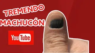C&oacute;mo curar un machuc&oacute;n de Dedo en 1 d&iacute;a.