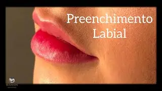 Preenchimento Labial - Harmonização Facial