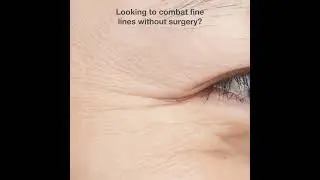 Are your fine lines and wrinkles starting to appear? 😥 Combat all these issues without surgery now!